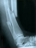 X-ray of a broken leg