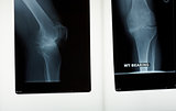 A x-ray of a knee joint