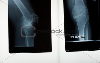 A x-ray of a knee joint