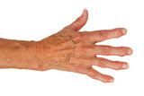 Hand of an old woman with arthritis