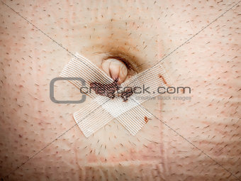 wound umbilical hernia