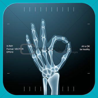 X-ray of both human hand (OK!), vector Eps10 illustration.
