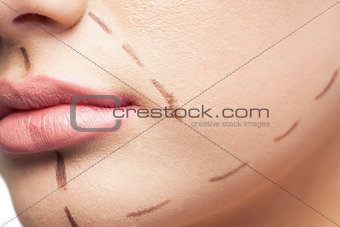 Extreme close up on gorgeous patient with dotted lines on the face