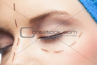 Extreme close up on relaxed patient with dotted lines on the face