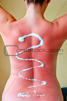 After-sun cream on her back 