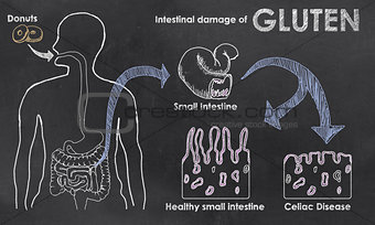 Intestinal Damage of Gluten