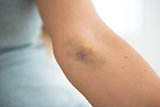 Closeup on bruise hand of drug addict young woman