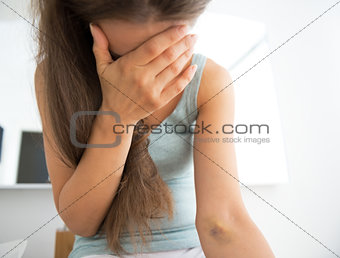 Closeup on drug addict young woman with bruise on hand