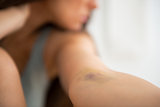 Closeup on drug addict young woman with bruise on hand