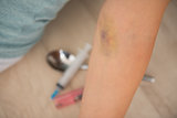 Closeup on bruise hand of drug addict young woman