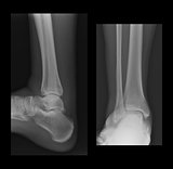 Ankle radiographs