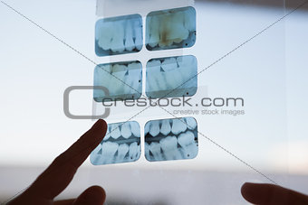 Dentists looking and pointing to xray