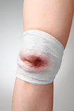 Injured knee with bloody bandage