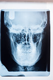 Close up of a x-ray of a human skull