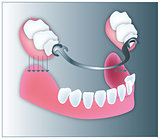 Dental illustration