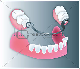 Dental illustration