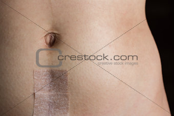 Stomach with Recovering Cesarean Section Scar