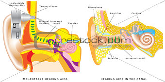Ear hearing aid