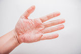 The problem with many people - eczema on hand. Isolated background