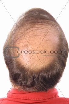 shot of a mans bald head upclose