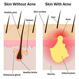 Skin with and without acne