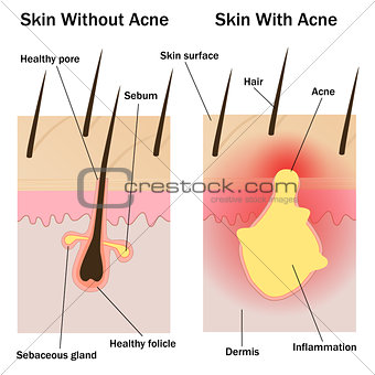 Skin with and without acne