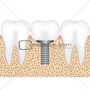 Dental implant with crown