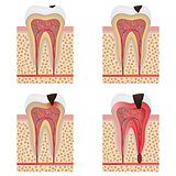 Development of dental caries illustration.