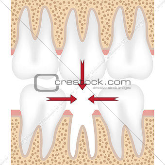 Illustration of missing tooth.
