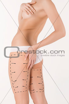 Cellulite removal plan. Black markings on young woman body