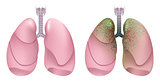 Healthy human lungs. Respiratory system. Lung, larynx and trachea of healthy person. Respiratory system smoker. Lung cancer