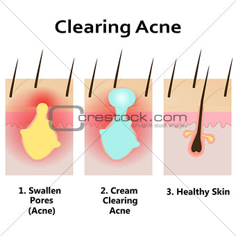 Illustration of clearing skin from acne.