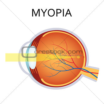 Myopia. Myopia is being short sighted.