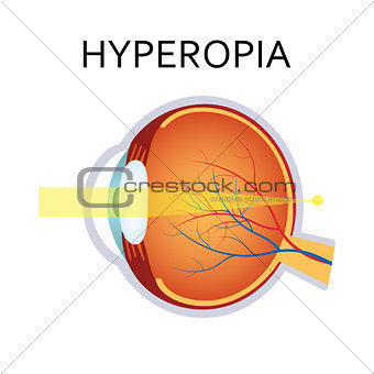 Hyperopia eyesight disorder.