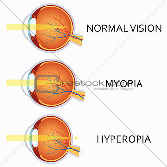 Optical human eye defects. Myopia and hyperopia.
