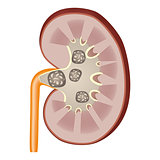 Kidney stones illustration.
