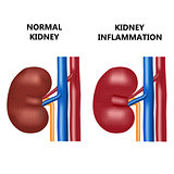 Healthy kidney and kidney infection.