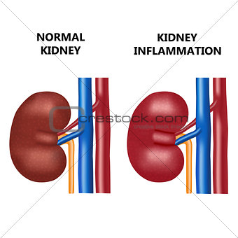Healthy kidney and kidney infection.