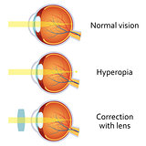 Hyperopia corrected by a plus lens