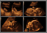 baby on ultrasound in the abdomen of a pregnant