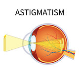 Illustration of astigmatism.