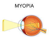 Illustration of myopia.
