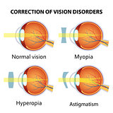 Correction of various eye vision disorder.