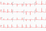 Typical human electrocardiogram, red graph with marks
