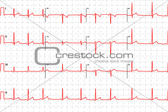 Typical human electrocardiogram, red graph with marks