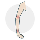 Problems with the limb joints