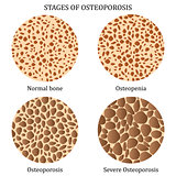 Stages of osteoporosis.