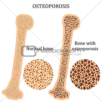 Healthy bone and osteoporosis bone.
