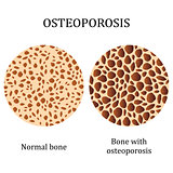 Healthy bone and bone with osteoporosis.