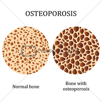 Healthy bone and bone with osteoporosis.